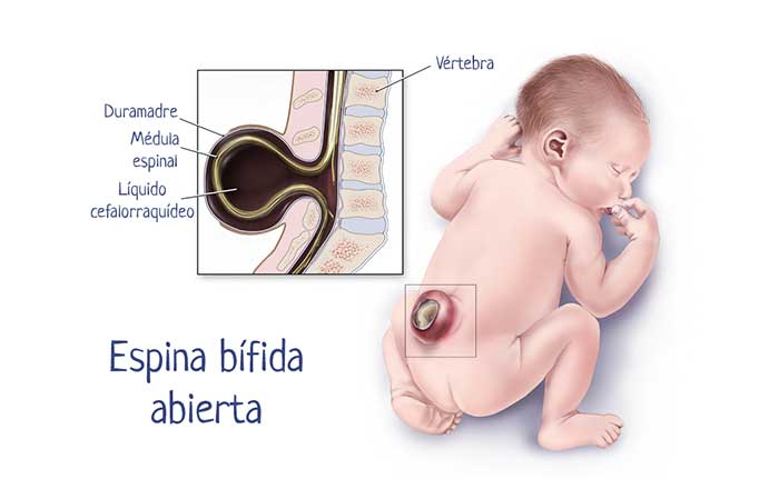 Espina bifida abierta